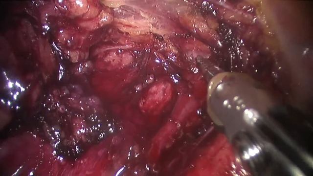 Robot assisted right recurrent lymph node dissection and nerve repair смотреть онлайн