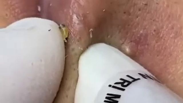 #черныеточки #acne #акне ##прыщ #