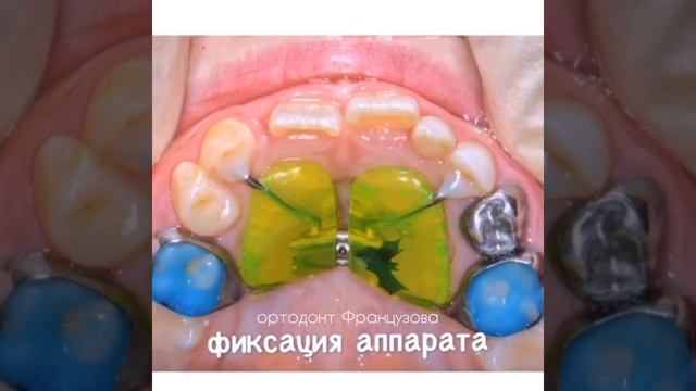 Как делают несъёмные детские пластинки смотреть онлайн