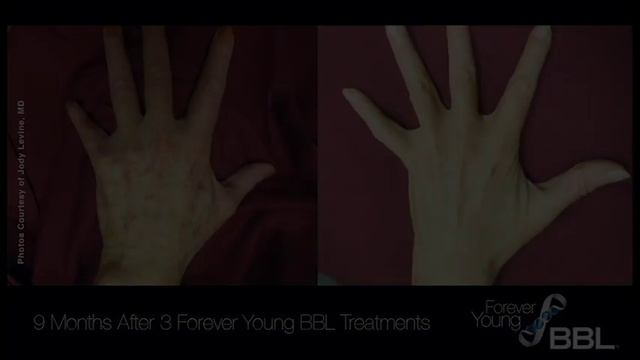 Forever Young BBL - Look Younger With Laser Skin Rejuvenation from South Coast MedSpa смотреть онлайн