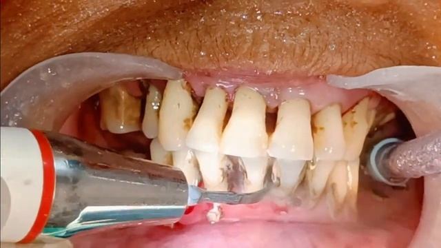 Massive Firm & Hard Black Calculus Removal by Ultrasonic Scaling I 1st Dental Cleaning in 35 years смотреть онлайн