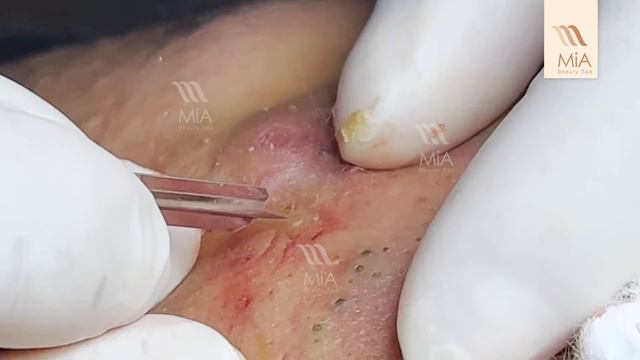SUPER BLACKHEADS At MiA Beauty Spa