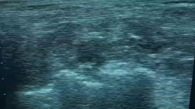 Продлённая проводниковая анестезия плечевого сплетения. смотреть онлайн