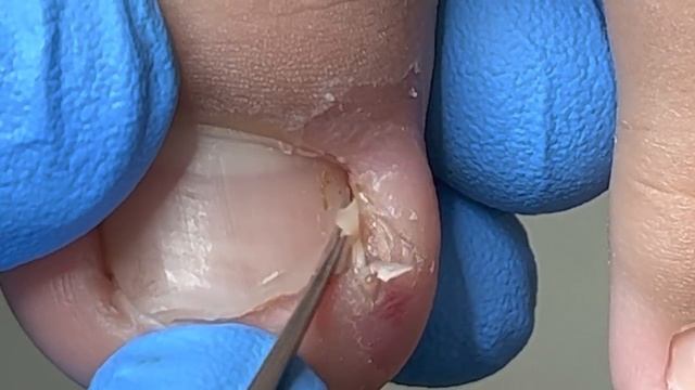 Huge Ingrown Nails & Toenails Heal Quickly【Xue Yidao】