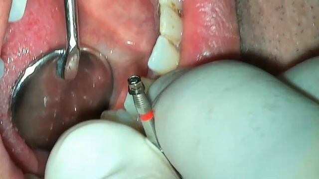 How to remove a broken abutment and broken screw fragment from an Astra dental implant in 2 minutes смотреть онлайн