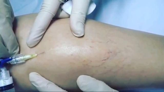 Удаление сосудистых звездочек смотреть онлайн
