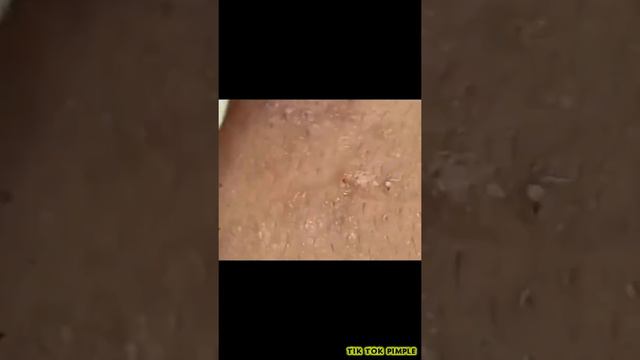 #1 TIK TOK PIMPLE VIDEO COMPILATION US UK | 21st August 2020