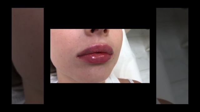 А что может ваш косметолог? Контурная пластика губ в ЦИДК!