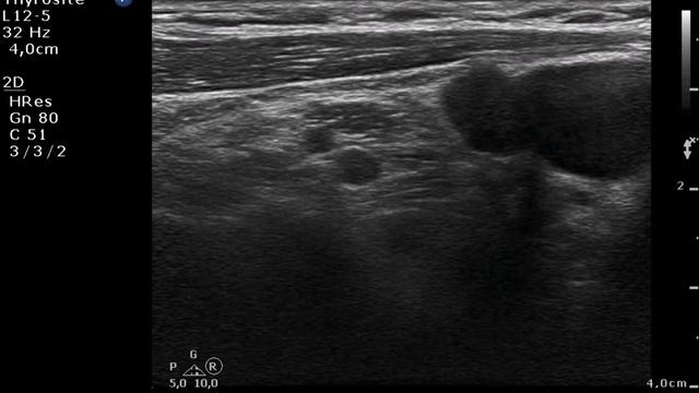 Metastasis of a ductal invasive breast cancer. Lymph nodes in the neck - case 4 смотреть онлайн