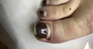 Переношено покрытие⚠️❗️ • Вросший ноготь?