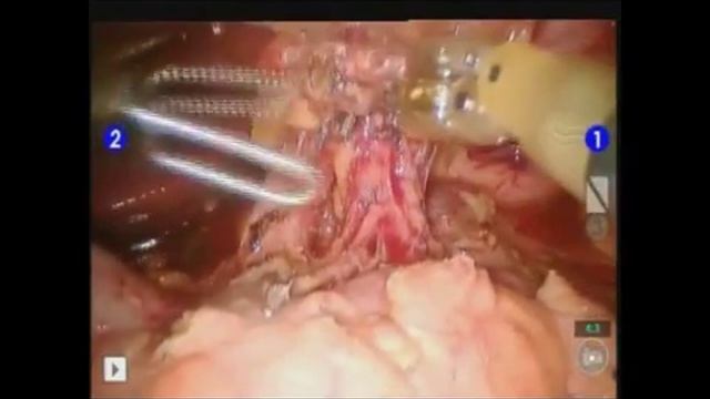 Laparoscopic and Robotic Total Gastrectomy for Stomach Cancer смотреть онлайн