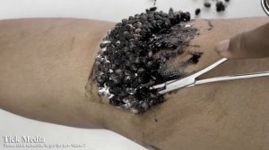 УЖАС! Чистка клещей на ногах человека