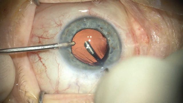 A Planned Anterior Vitrectomy смотреть онлайн