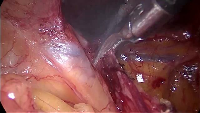 Видеолапароскопическая TAPP Stoppa пластика двусторонней паховой грижи