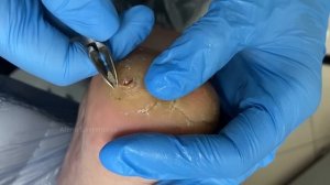 Когда пора к хирургу / Трещины на пятке / кератоз на пятке / Последствия / Кератоз Что делать