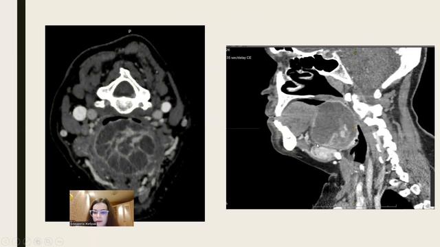 14. ЛЕЧЕБНО-ДИАГНОСТИЧЕСКИЙ АЛГОРИТМ ВЕДЕНИЯ ПАЦИЕНТА С ЭКТОПИЕЙ ЩИТОВИДНОЙ ЖЕЛЕЗЫ смотреть онлайн