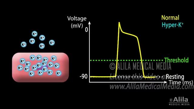 Hyperkalemia: Causes, Effects on the Heart, Pathophysiology, Treatment, Animation. смотреть онлайн