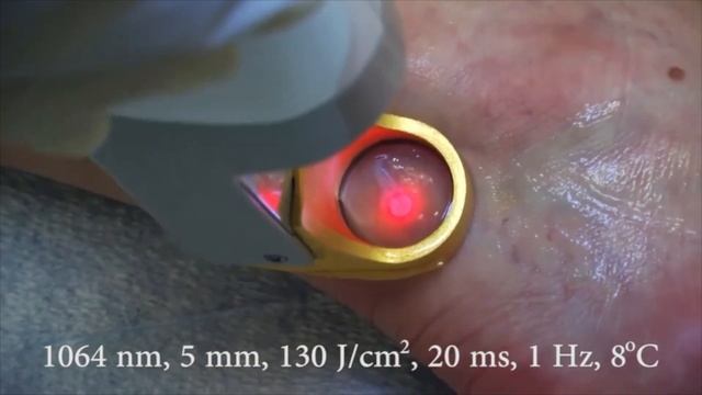 Vascular Laser Treatment with Excel HR at Miami Skin Spa. смотреть онлайн