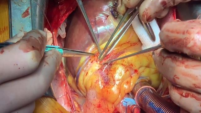 Тромб в сердце ❤