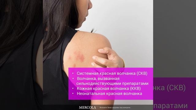 ВСЕМИРНЫЙ ДЕНЬ ВОЛЧАНКИ (10 мая) смотреть онлайн