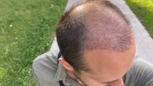 Пересадка волос. Три месяца (90 дней)