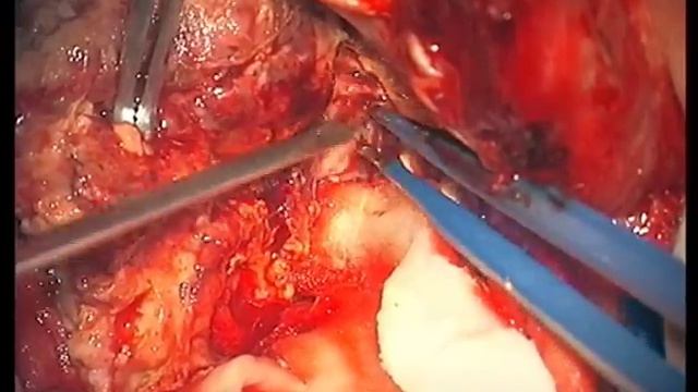 Глиобластома правой височной доли / Right Temporal Glioblastoma