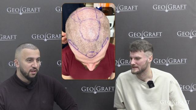 Пересадка волос в России, цена 90-120 тыс. Отзыв пациента. Немного о плазмотерапии. смотреть онлайн