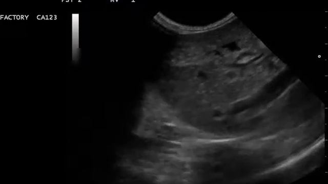 5 Каудальная полая вена смотреть онлайн