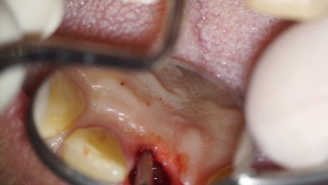 Atraumatic Root Extraction by means of an endodontic file - Dr Fabio Cozzolino смотреть онлайн