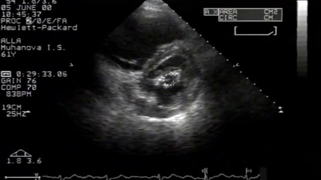 Митральный стеноз. Эхокардиография © Mitral stenosis. Echocardiographic diagnosis смотреть онлайн
