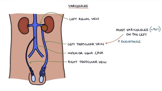 Varicoceles смотреть онлайн