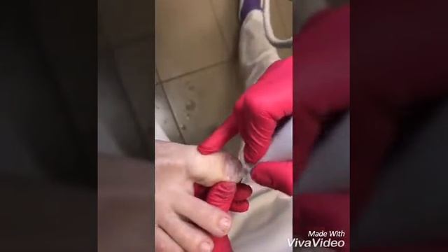 Удаление ногтевых пластин!!! смотреть онлайн