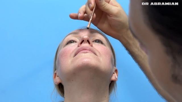 Омоложение лица +ринопластика: Светлана из Норвегии смотреть онлайн