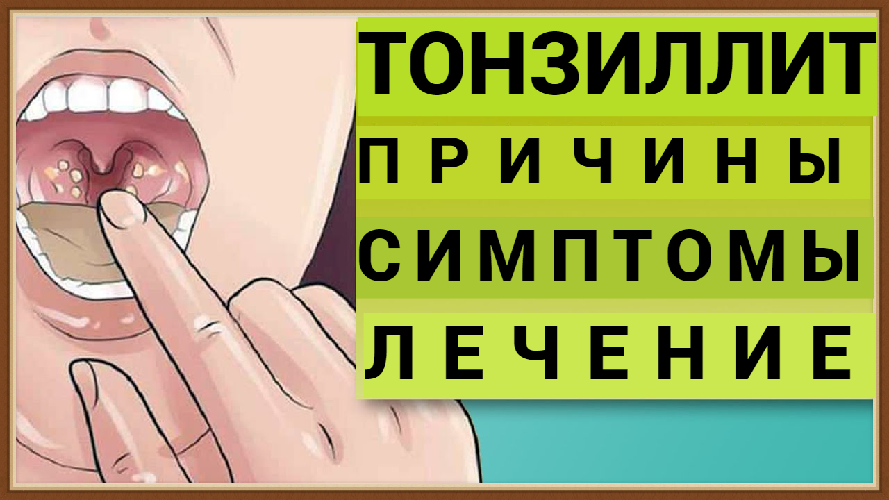 ТОНЗИЛЛИТ - ПРИЧИНЫ СИМПТОМЫ ЛЕЧЕНИЕ смотреть онлайн