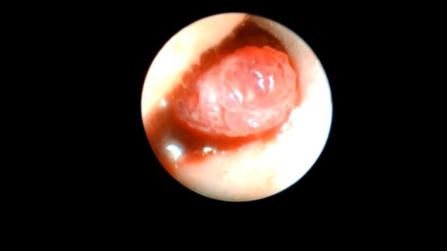 Холестеатома в ухе у кота. Эндоскопия смотреть онлайн