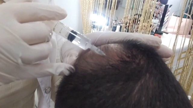 #Мезотерапия для волос #Mezoterapiya Soch Uchun