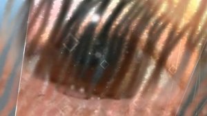 ★ Как убрать ячмень на глазу. Методы лечения ячменя на глазу. Антибактериальные кремы от ячменя