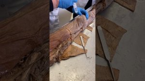 Топографическая анатомия: Пункция коленного сустава