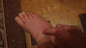 перелом пятой плюсневой кости