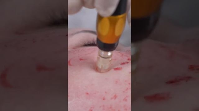 Микроигольчатая терапия и все что нужно о ней знать! смотреть онлайн