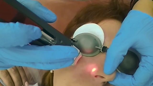 Удаление сосудистых звездочек на лице лазером смотреть онлайн