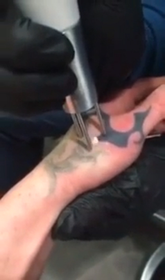 Лазерное удаление татуировки смотреть онлайн