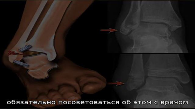 Реабилитация после перелома лодыжки смотреть онлайн
