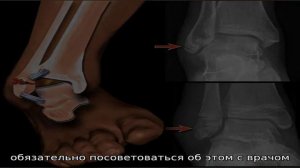 Реабилитация после перелома лодыжки