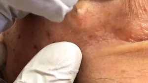 Removes acne | Давим прыщи | чёрные точки | Залипательно 2022