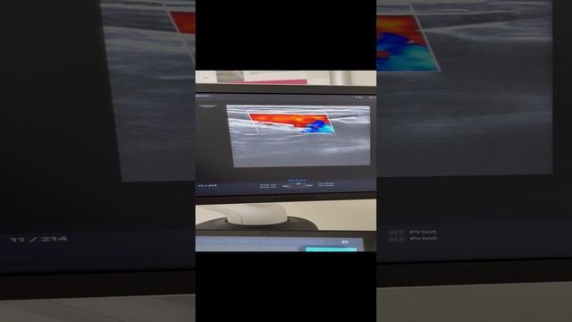 Варикоз по узи. Нужна операция. Внешних проявлений нет. Флеболог Москва смотреть онлайн