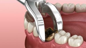 Удаление коренного зуба, поврежденного кариесом