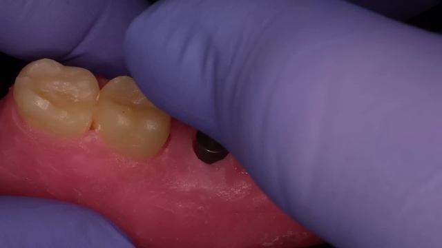 Step by Step Dental Implant Procedure - Back Molar смотреть онлайн