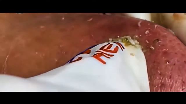 Removes Acne, Давим прыщи, чёрные точки. Залипательно 2021