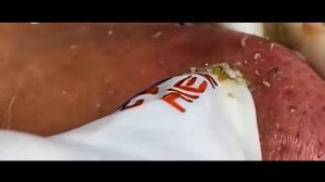 Removes acne, Давим прыщи, чёрные точки. Залипательно 2021